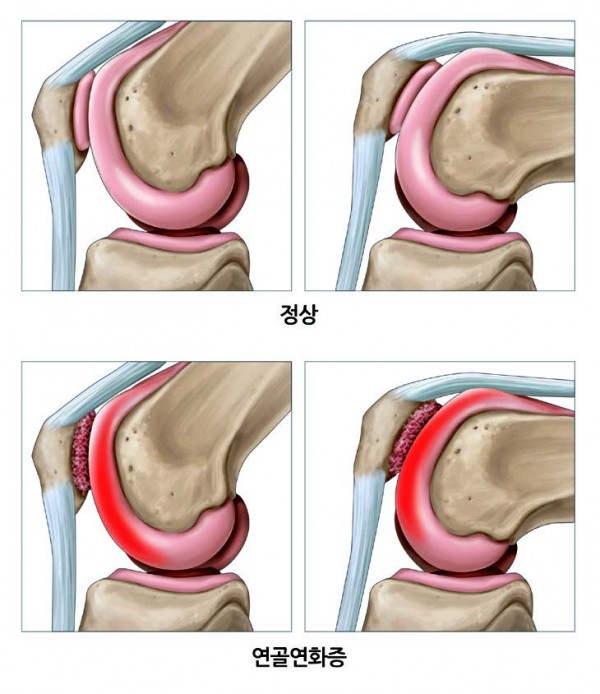 연골연화와 무릎 통증 의 관계 그리고 치료방법 3가지 2 연골연화증