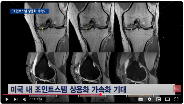 네이처셀 기업 실적 추이와 2025-2026 매출 전망 심층 분석 4 네이처셀 조인트스템 FDA 승인